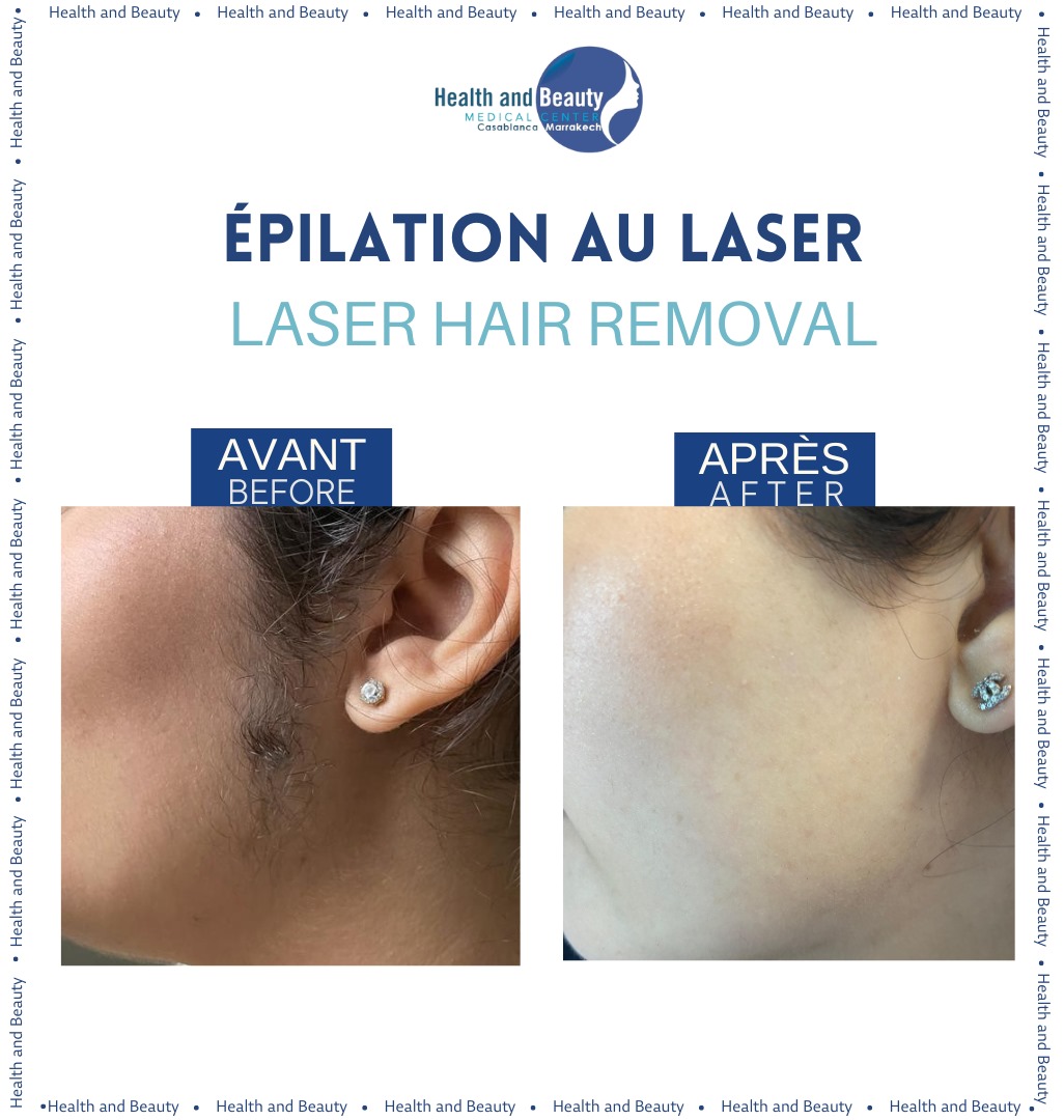  avant-apres-epilation-definitive-resultat-incroyable