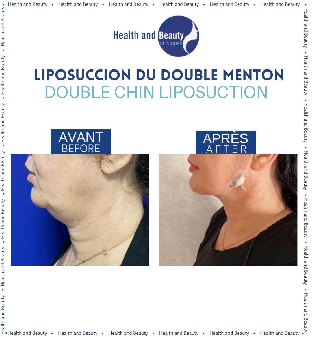 resultat-avant-apres-liposuccion-du-double-menton-maroc-clinique-chirurgie-esthetique