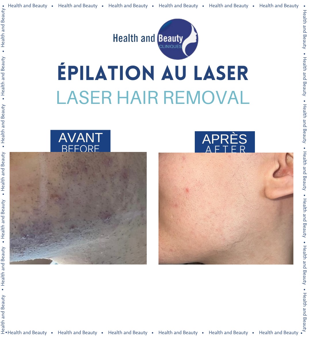 epilation-laser-visage-resultat-incroyable-avant-apres-laser-medical