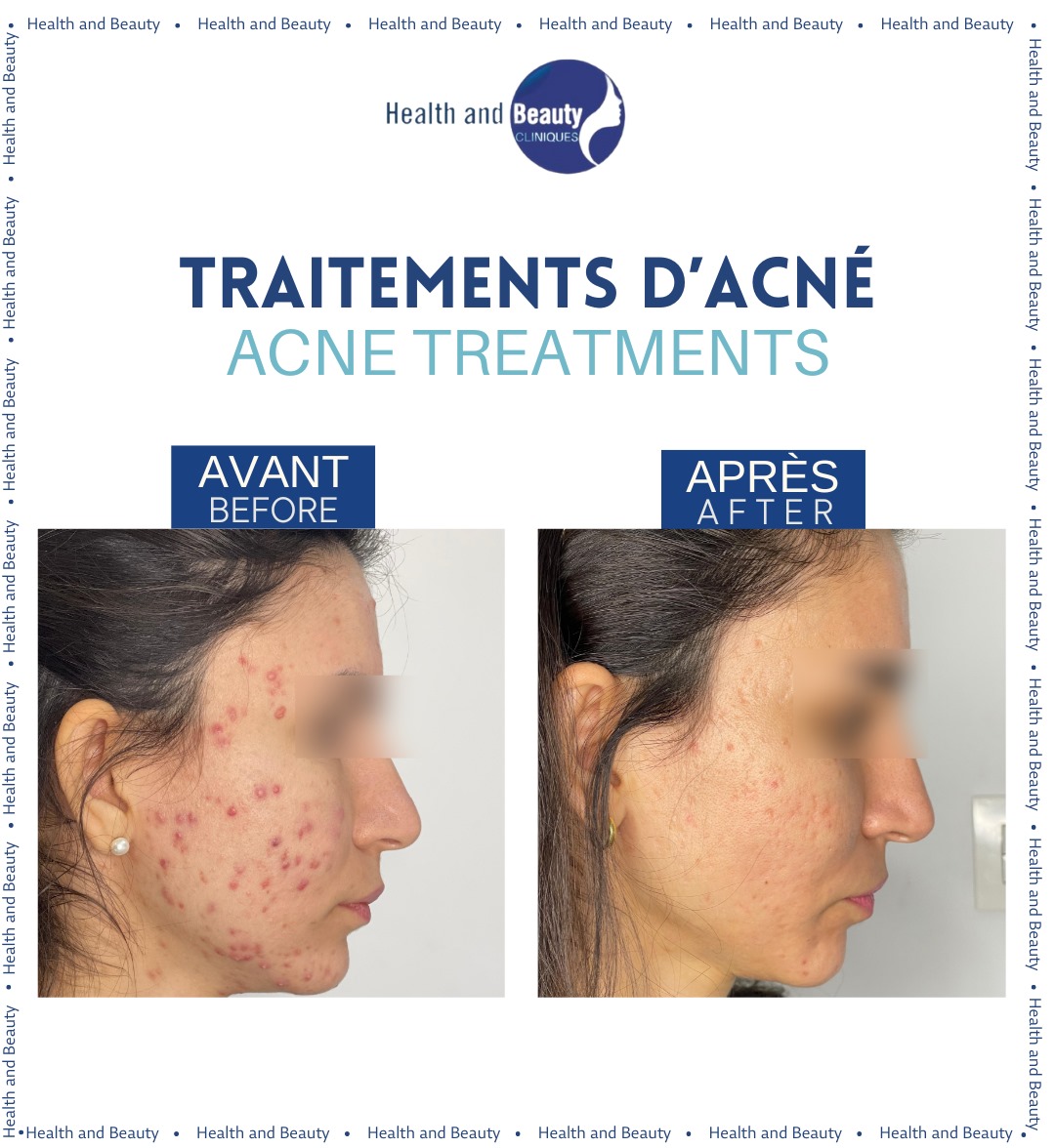 traitement-acne-imperfection-cutanee-resultat-une-seance-consultation-dermatologue-avant-apres-microneedling