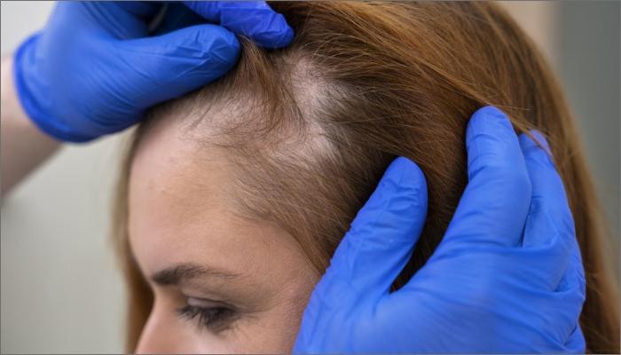 femmes-avec-perte-de-cheveux-progressive