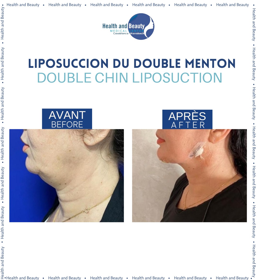 Body-contouring-fesses-solution-non-invasif