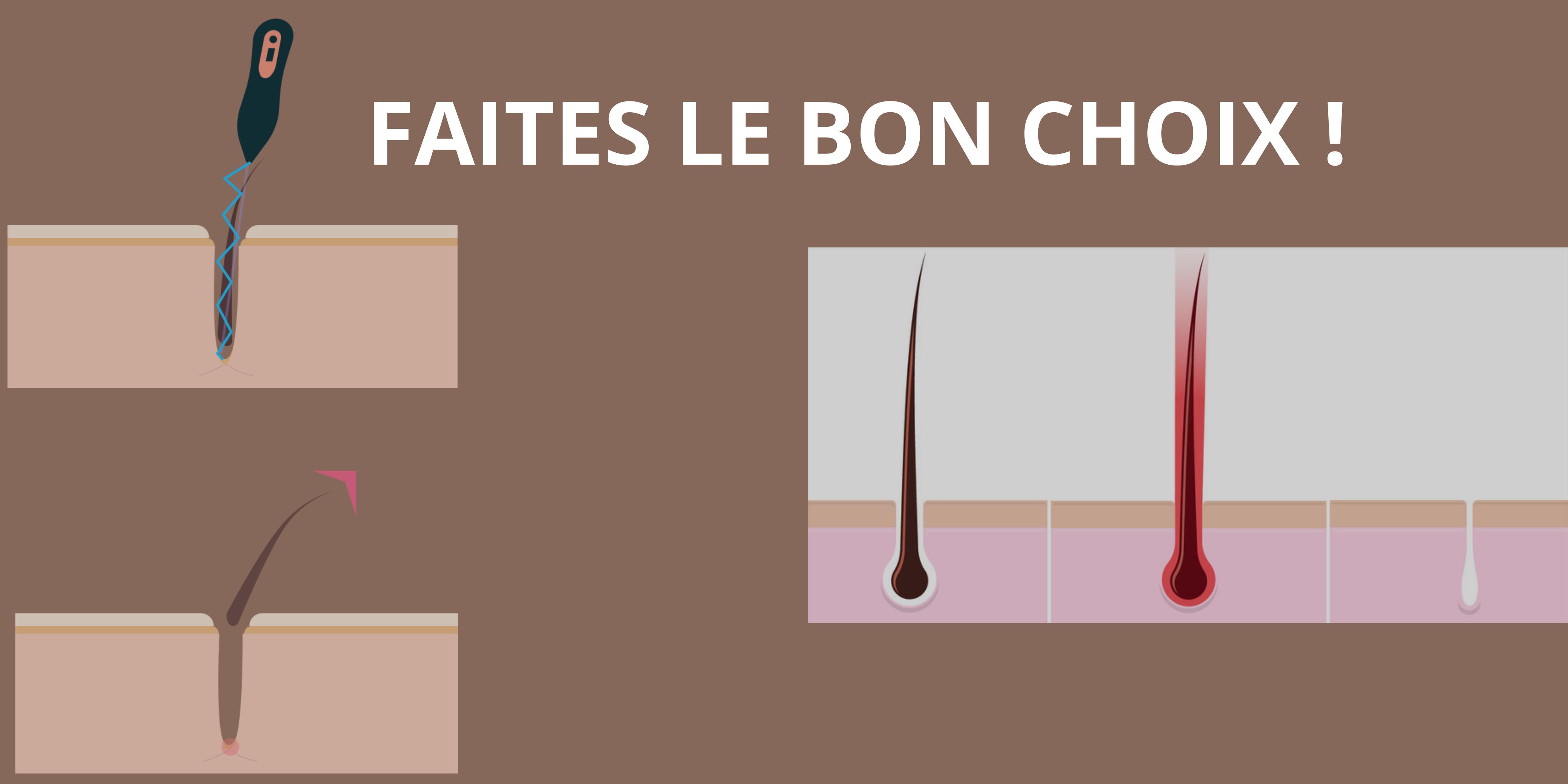 difference-entre-epilation-definitive-au-laser-et-electrolyse-apilus