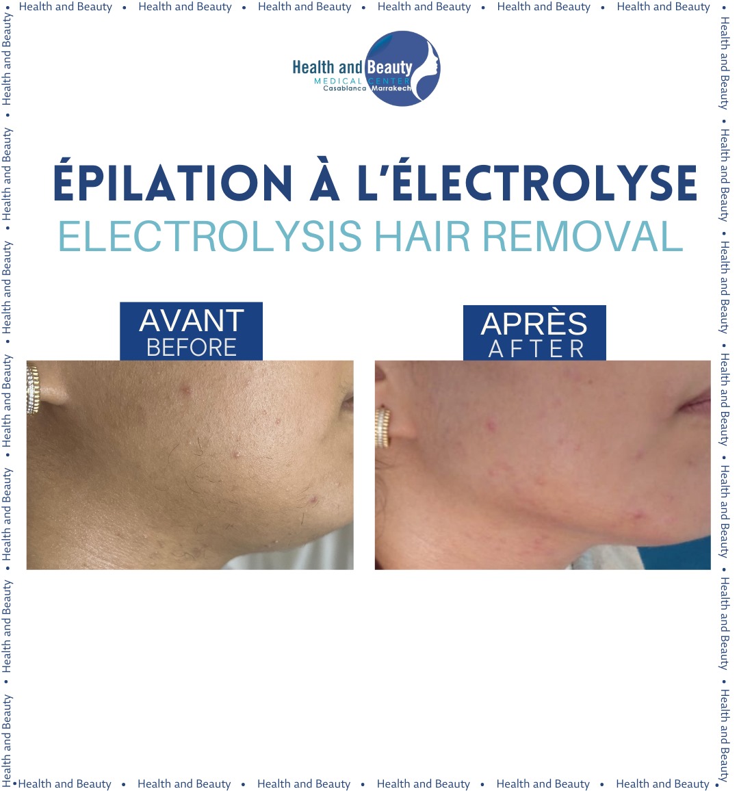 avant-apres-resultat-electrolyse-zone-menton