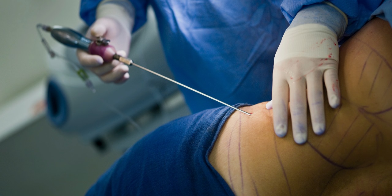 liposuccion_au_Maroc-chirurgie-esthetique