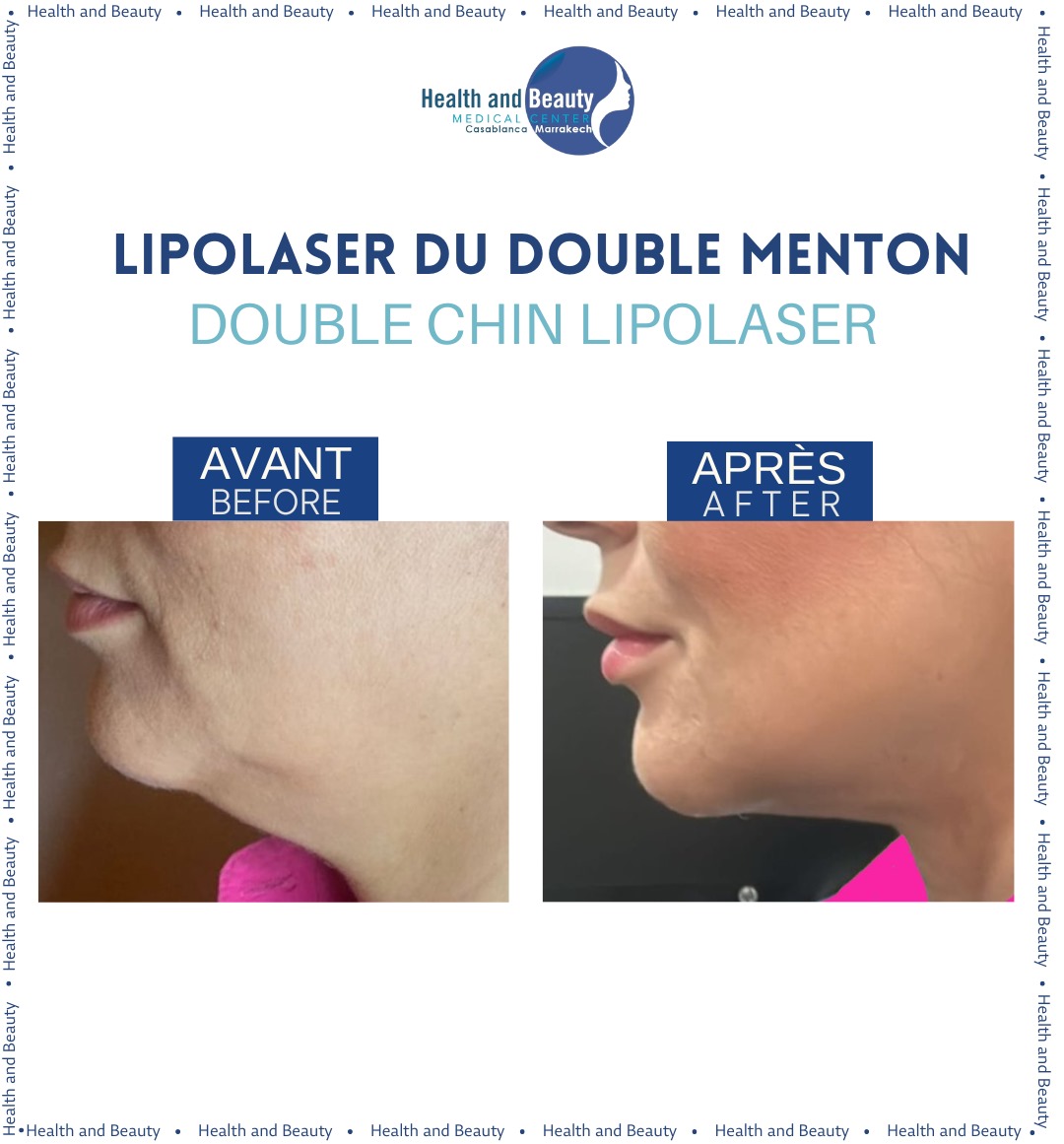 liposuccion-au-laser-innovation