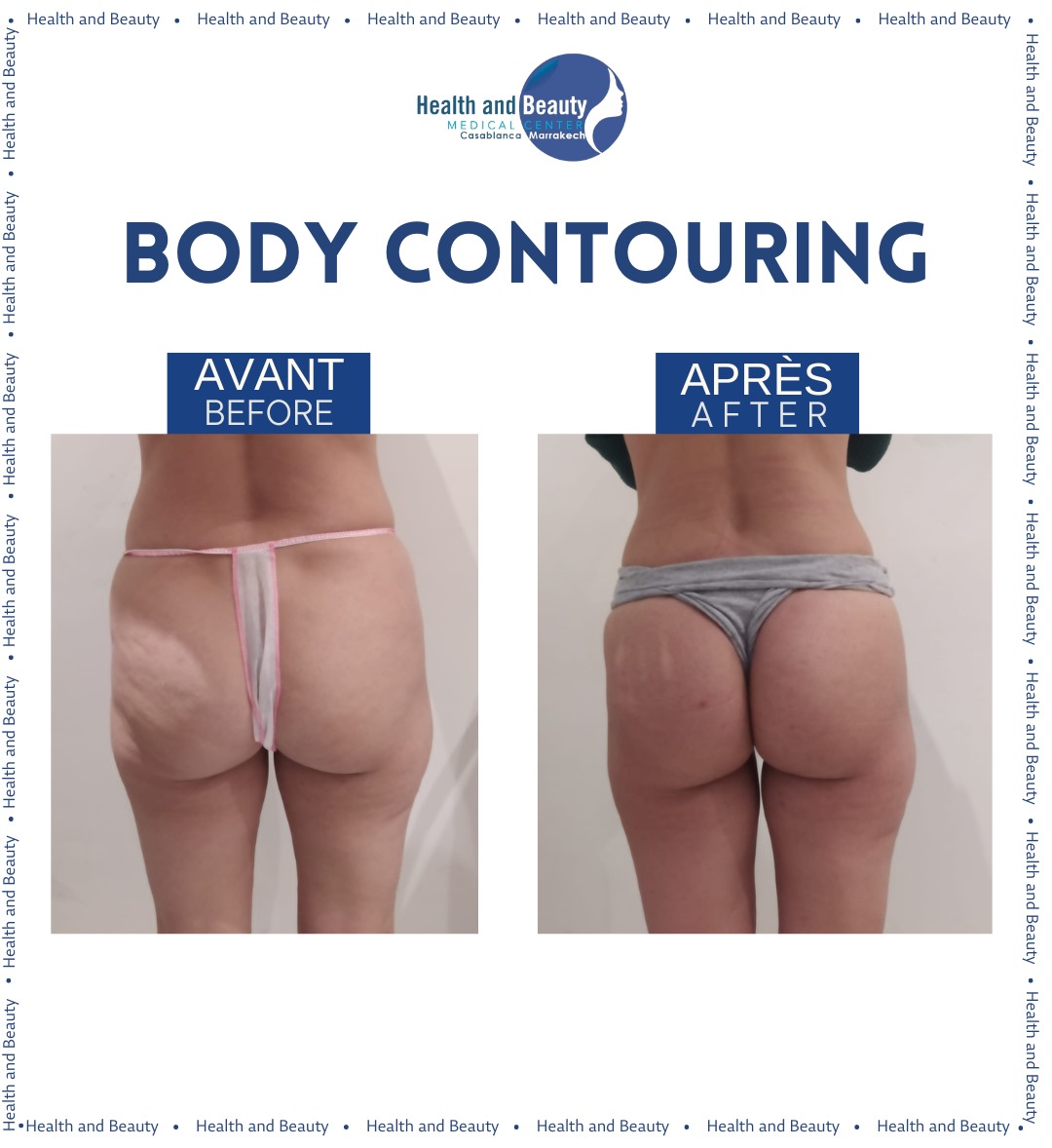 Body-contouring-fesses-solution-non-invasif