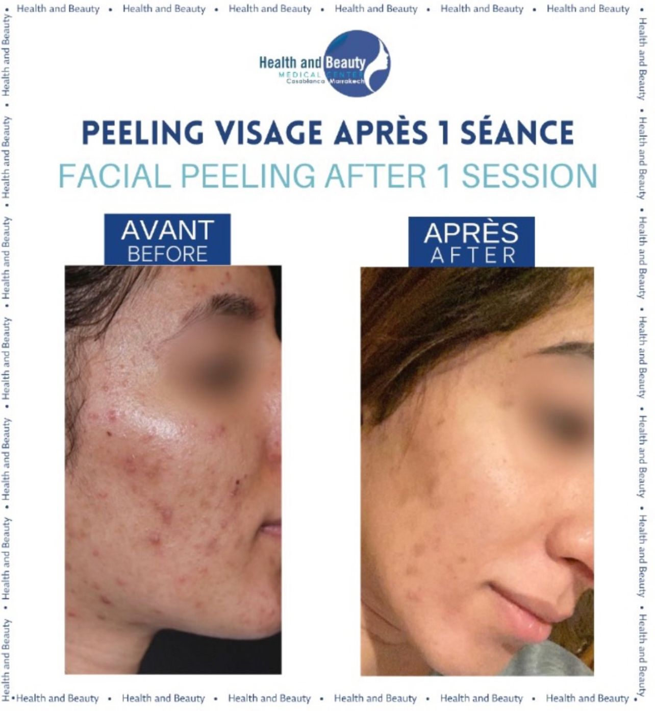 avant-après-peeling-visage-resultat